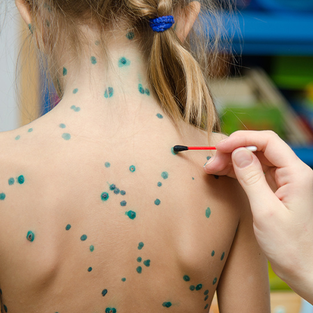 Лучше переболеть? 5 вопросов о ветряной оспе